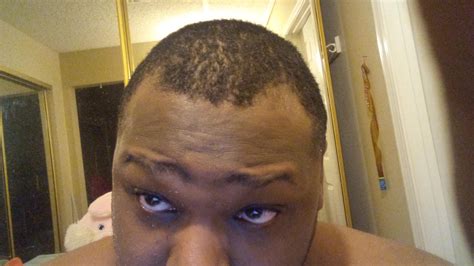 Any Tips On Getting My Hairline Fixed R Malehairadvice