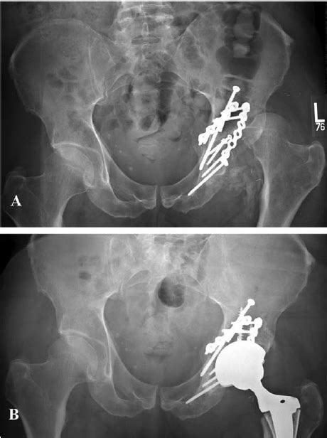 Anteroposterior Ap Preoperative A And Postoperative B Radiographs