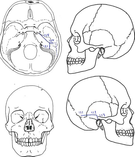 Sketch illustrating the six individual fracture lines of a single... | Download Scientific Diagram