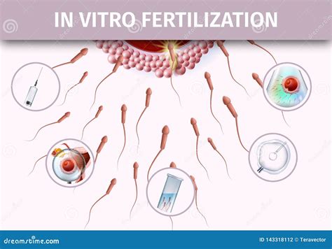 Artificial Insemination Infographic Aid Banner Stock Vector