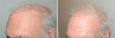 Body Hair Transplant Photos Miami Fl Patient123760