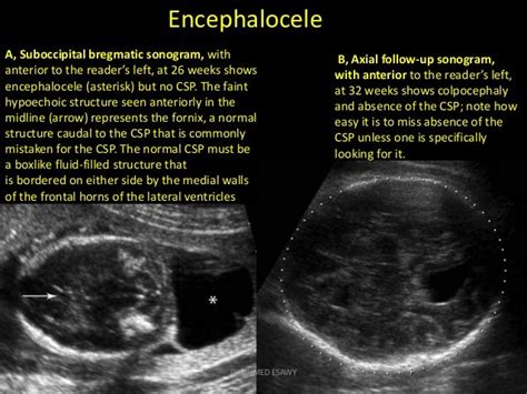 6 Fetal Skull Dr Ahmed Esawy