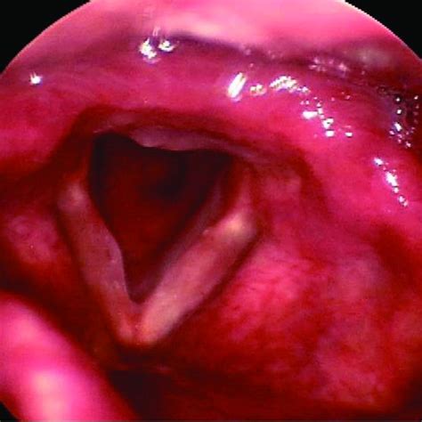 The Submucosal Lesion Shows Multinodular Chondroid Tissue And Mature