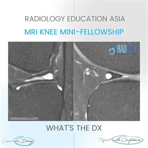 Meniscal Cyst Radiology Intrameniscal Tear Mri Knee Radiology