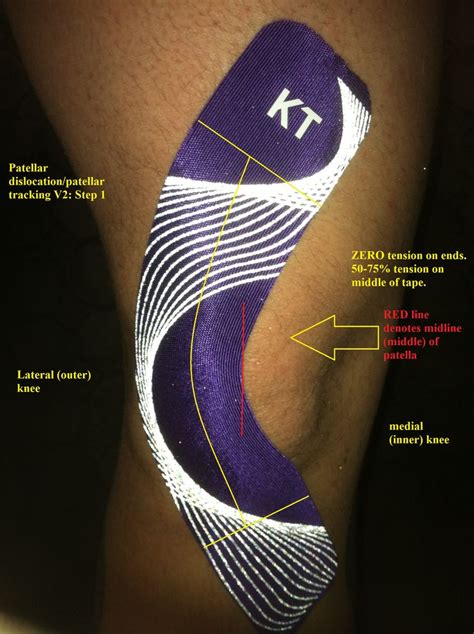 Kt Tape For Patella Sublaxation Kt Tape Knee Knee Taping Kt Tape