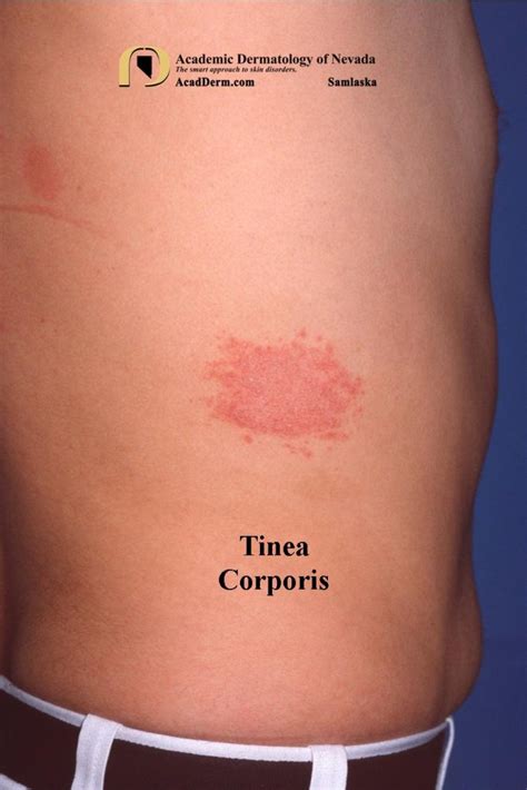 Tinea Corporis