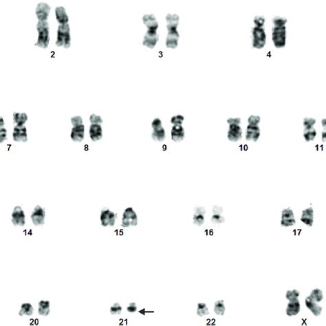 G Banding Analysis Of Bone Marrow From A Patient With Cll And Secondary