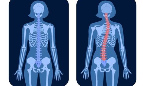 Impacto De La Escoliosis En Tu Salud Causas S Ntomas Y Opciones De