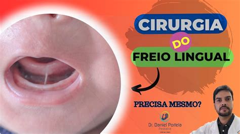 Cirurgia Do Freio Lingual Precisa Mesmo Youtube