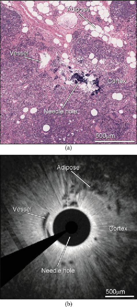 Figure 1 From Imaging Of Breast Cancer With Optical Coherence