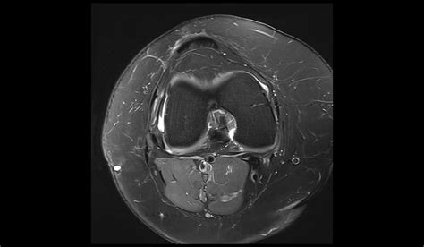 Anterior cruciate ligament tear MRI | Radiology Article on ACL tear