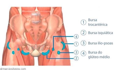 Tratamentos Para Bursite No Quadril