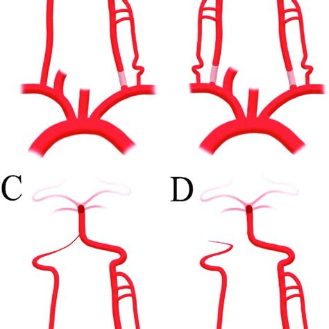 Illustration Of The Distal Angiographic Classification Of Vertebral