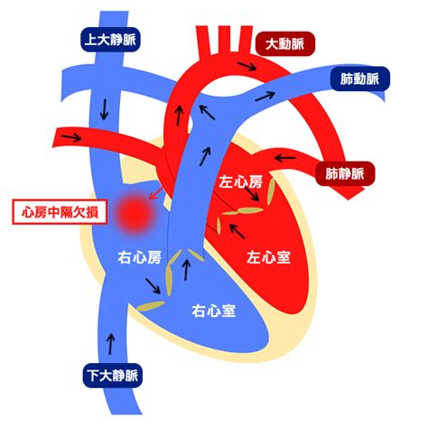 閉鎖栓を用いた心房中隔欠損症のカテーテル治療｜新東京病院