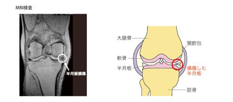 半月板損傷 ｜ 前原外科・整形外科 小児科｜医療法人 利靖会｜愛知県豊明市