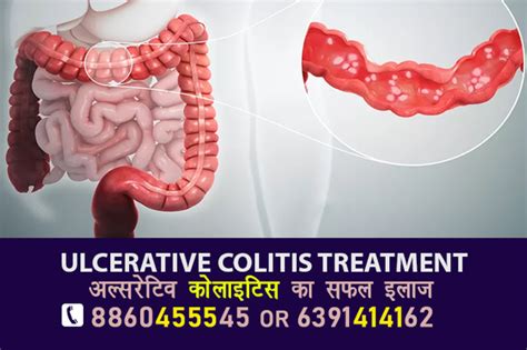 Ulcerative Colitis Treatment Deoria 8860455545 Lucknow