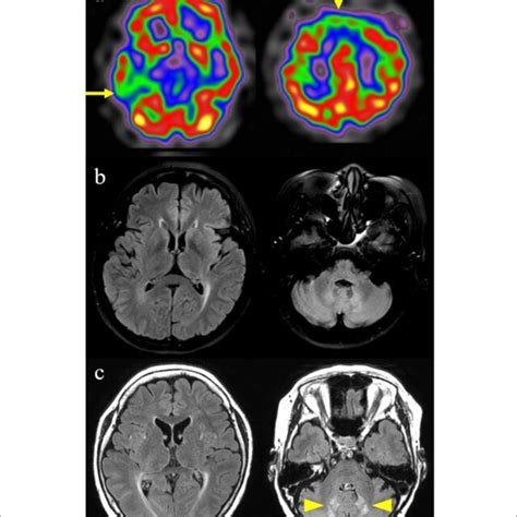 Figure E Xanthomas Findings Of This Patient With Cerebrotendinous