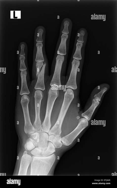 Broken Middle Finger X Ray