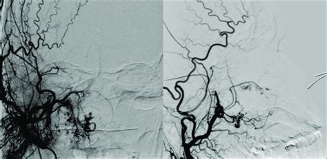 Right Maxillary Hemangioma Arteriography Arteriography Demonstrates Download Scientific