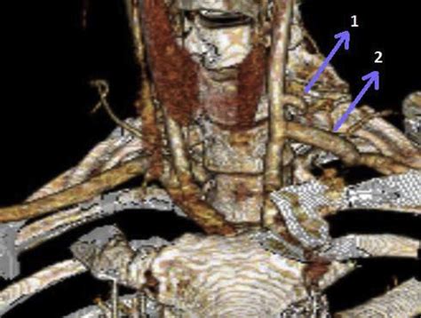 Follow Up Computed Tomography Ct Angiogram Showing Contrast Material