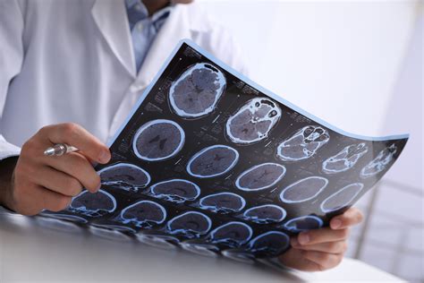 Classifications Of Brain Injuries Herrling Clark Law Firm