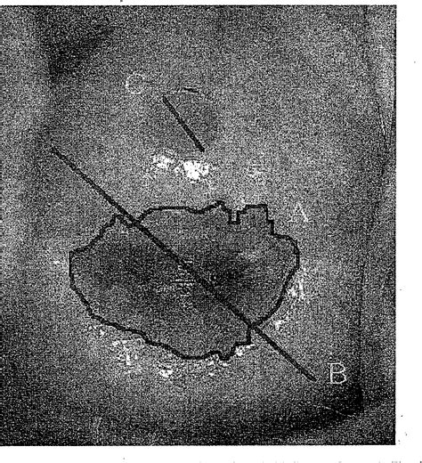 Figure 1 From Computerized Planimetry Versus Clinical Assessment For