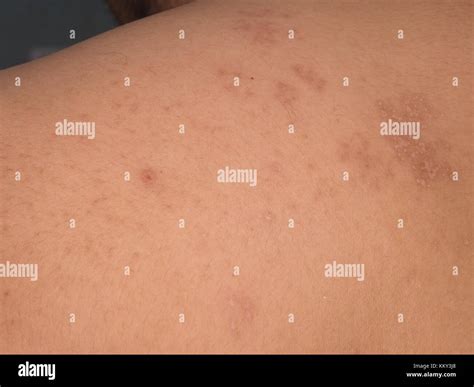 Scar After Illness From Herpes Zoster Stock Photo Alamy