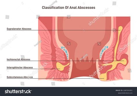 Discomfort Pain Anal Area Over Royalty Free Licensable Stock Vectors