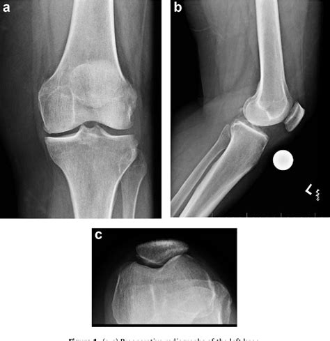 Figure From Flexion Contracture Due To Cyclops Lesion After