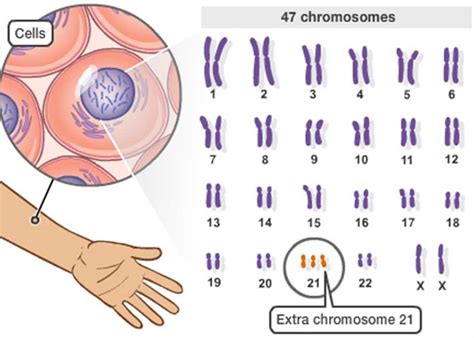 About Down Syndrome - Manasota BUDS