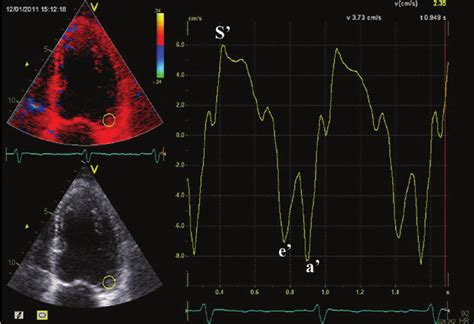 Colour Tissue Doppler On The Left Ventricle Mitral Annular Velocities