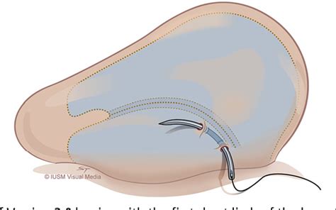 Figure From Incisionless Otoplasty Semantic Scholar