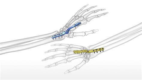 Acumed Introduces New Solution to Help Treat Post-Traumatic Arthritis: Total Wrist Fusion ...