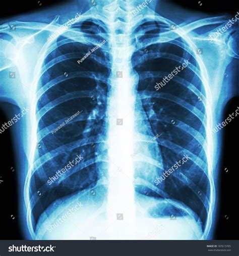 1 906 Normal Chest X Ray Images Stock Photos 3D Objects Vectors