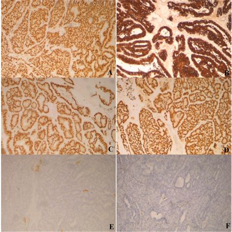 Cribriform Morular Thyroid Carcinoma A Case Report With Review Of The