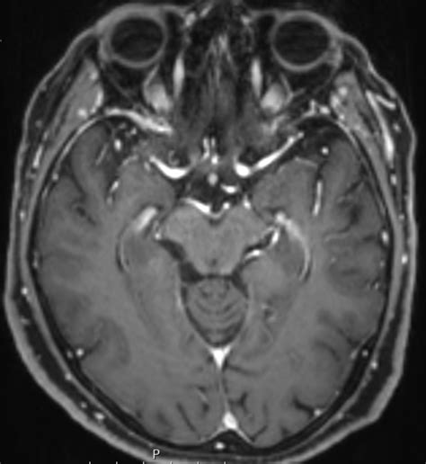 Mp Rage Sequenz Mri Ars Neurochirurgica