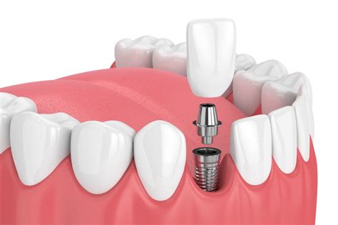 How Dental Implants Work – Ambience Dental