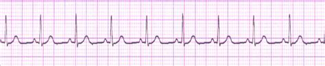 Fig Normal Ecg Signal Ecg Compression Techniques Are Mainly