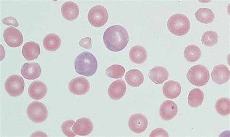 Anisocytosis – Cells and Smears