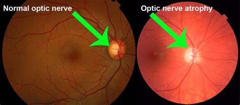 Optic Atrophy - Optography