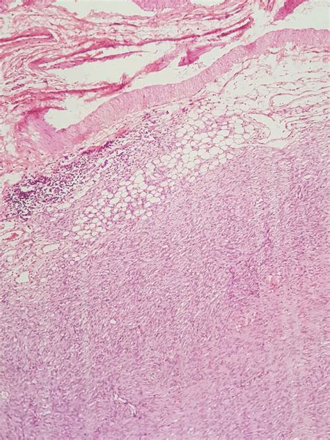 Sections Of Ill Defined Mesenchymal Neoplasm Involving Papillary And