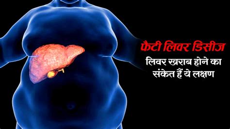 Fatty Liver Disease लिवर हो गया है खराब अगर पेट में दिखें ये 2 लक्षण