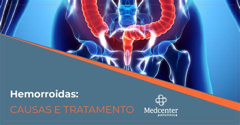 Hemorroidas causas sintomas tratamentos e prevenção Blog Medcenter