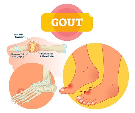 Gout Vector Illustration Swollen And Inflamed Joint Labeled Scheme Stock Illustration - Download ...