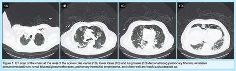 Dermatomyositis Related Ild After Treatment With Ticagrelor Jacc