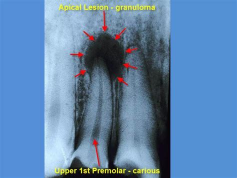 DIFFERENTIAL DIAGNOSIS FOR PERIAPICAL RADIOLUCENCY.pptx