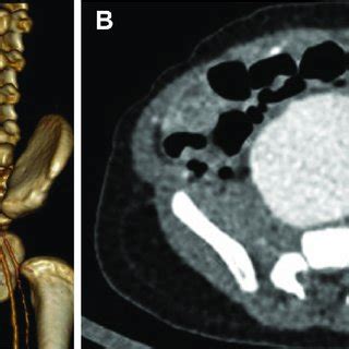 Computed Tomography Angiography CTA A Three Dimensional Volume