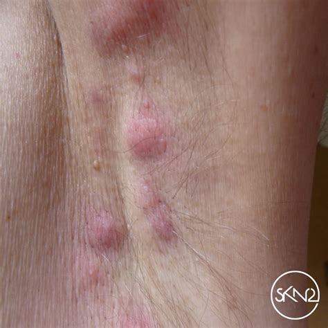Acne Inversa Hidradenitis Suppurativa Behandelopties En Kosten