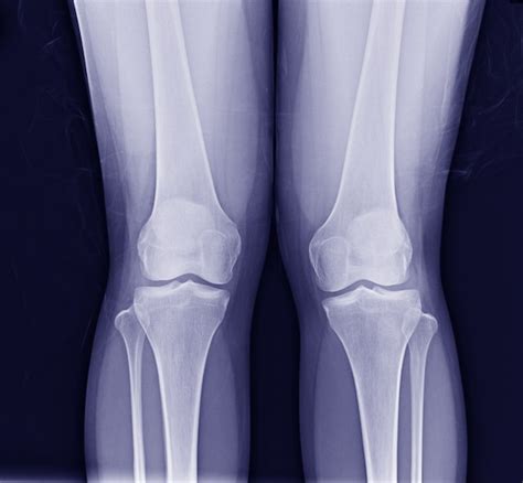 Arthrose Oa Du Genou Radiographie Assistée Par Ordinateuragrand Vue