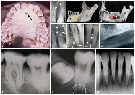 Submandibular Fossa Radiograph